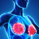 Illustration for article titled Fighting Breast Cancer: Tuskegee University Researchers Add a 4th Marker in Breast-Cancer Detection